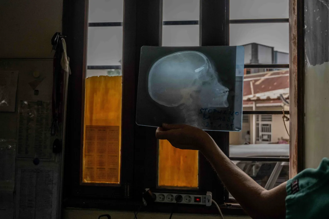 North Kivu. A medical staff member shows an X-ray image showing a bullet lodged in the skull. A medical staff member shows an X-ray image showing a bullet lodged in the skull.